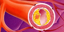 痛風の合併症・虚血性心疾患