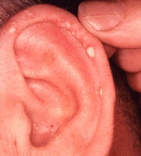 痛風結節・耳の写真